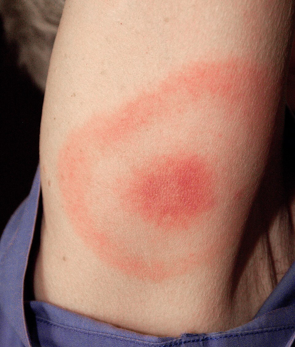 Logo maladie de Lyme